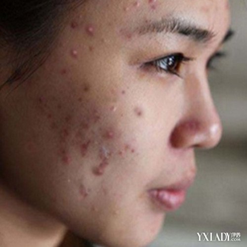 脸上长痘痘的主要原因 痘痘肌肤形成的主要因素